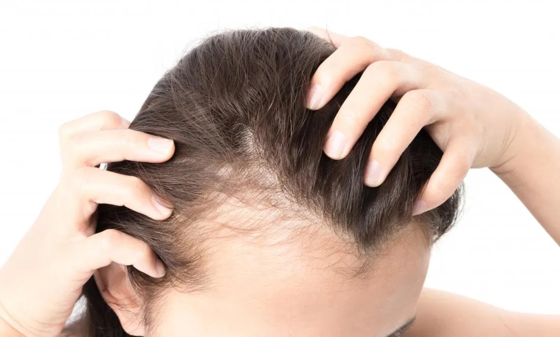 Causes of Hair Loss In Women And Need For Hair Transplantation