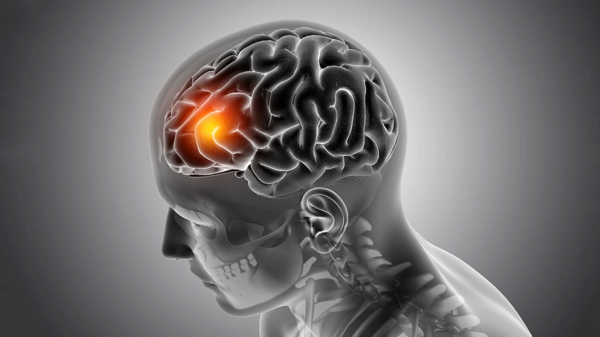 Brain tumor myths and facts